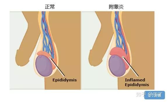 睾丸胀痛是什么原因