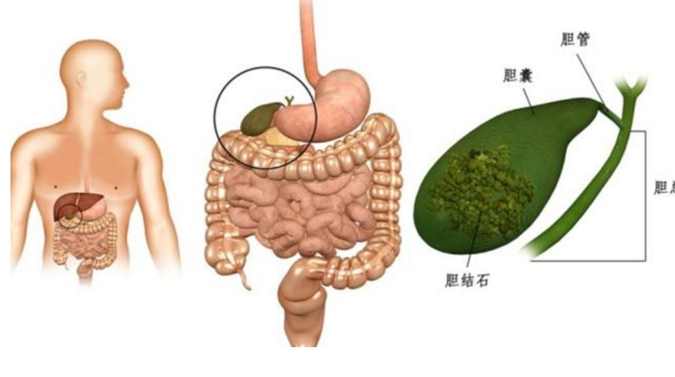 胆囊炎疼痛位置图是在哪里呢