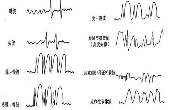 怎样的脑电图才是癫痫病