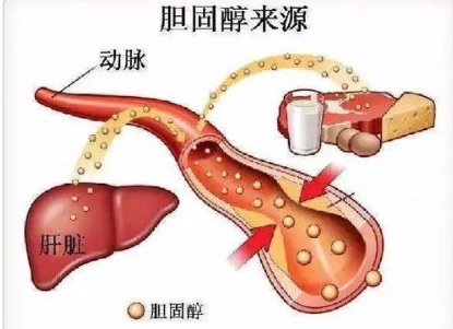 高胆固醇血症