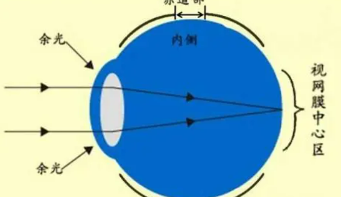 屈光度是什么意思