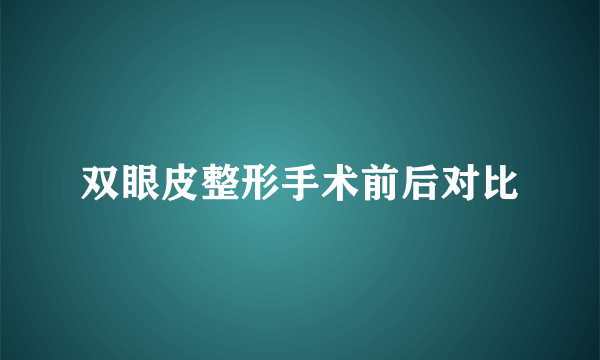 双眼皮整形手术前后对比