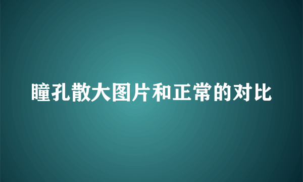 瞳孔散大图片和正常的对比